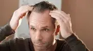 Hair Loss Myths 2